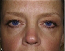 Brow Lift Before Photo by Mariam Awada, MD, FACS; Southfield, MI - Case 40223