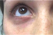 Dermal Fillers After Photo by Mariam Awada, MD, FACS; Southfield, MI - Case 40267