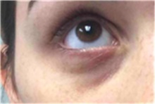 Dermal Fillers Before Photo by Mariam Awada, MD, FACS; Southfield, MI - Case 40267