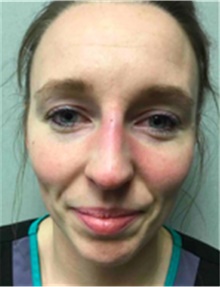Dermal Fillers After Photo by Mariam Awada, MD, FACS; Southfield, MI - Case 40268