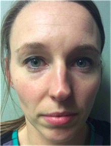 Dermal Fillers Before Photo by Mariam Awada, MD, FACS; Southfield, MI - Case 40268