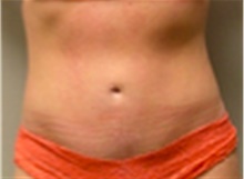 Mommy Makeover After Photo by Mariam Awada, MD, FACS; Southfield, MI - Case 40277