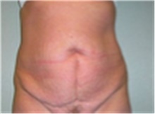 Mommy Makeover Before Photo by Mariam Awada, MD, FACS; Southfield, MI - Case 40277