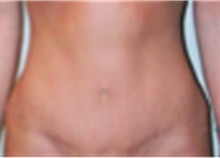 Mommy Makeover After Photo by Mariam Awada, MD, FACS; Southfield, MI - Case 40284