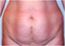 Mommy Makeover Before Photo by Mariam Awada, MD, FACS; Southfield, MI - Case 40284