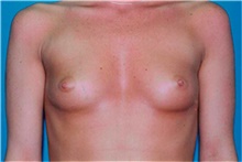 Breast Augmentation Before Photo by David Rapaport, MD; New York, NY - Case 40460