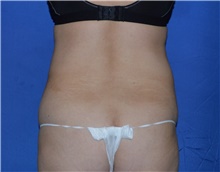 Liposuction Before Photo by Karol Gutowski, MD, FACS; Glenview, IL - Case 40566