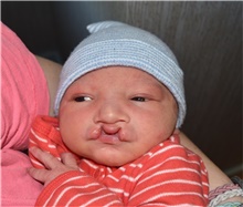 Cleft Lip and Palate Repair Before Photo by Rachel Ruotolo, MD; Garden City, NY - Case 41338