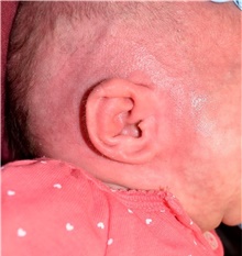 Ear Surgery After Photo by Rachel Ruotolo, MD; Garden City, NY - Case 41396