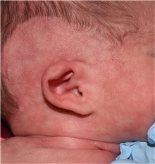 Ear Surgery Before Photo by Rachel Ruotolo, MD; Garden City, NY - Case 41396