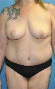 Body Lift After Photo by Joshua Cooper, MD; Seattle, WA - Case 41787