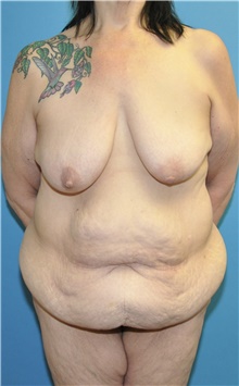 Body Lift Before Photo by Joshua Cooper, MD; Seattle, WA - Case 41787