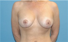 Breast Lift After Photo by Scott Sattler, MD,  FACS; Seattle, WA - Case 41896