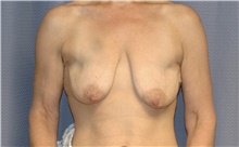 Breast Lift Before Photo by Scott Sattler, MD,  FACS; Seattle, WA - Case 41896