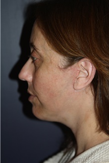 Facelift After Photo by Larry Weinstein, MD; Chester, NJ - Case 42064