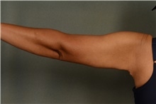 Arm Lift After Photo by Ellen Janetzke, MD; Bloomfield Hills, MI - Case 42771