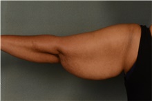 Arm Lift Before Photo by Ellen Janetzke, MD; Bloomfield Hills, MI - Case 42771