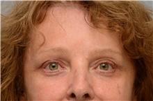 Botulinum Toxin After Photo by Carlos Rivera-Serrano, MD; Miami Beach, FL - Case 43630