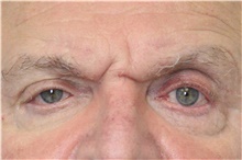 Botulinum Toxin Before Photo by Carlos Rivera-Serrano, MD; Miami Beach, FL - Case 43631