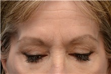 Botulinum Toxin Before Photo by Carlos Rivera-Serrano, MD; Miami Beach, FL - Case 43633