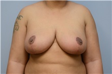 Breast Reduction After Photo by Carlos Rivera-Serrano, MD; Miami Beach, FL - Case 43660