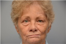 Brow Lift After Photo by Carlos Rivera-Serrano, MD; Miami Beach, FL - Case 43665