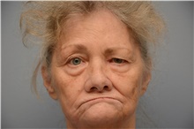 Brow Lift Before Photo by Carlos Rivera-Serrano, MD; Miami Beach, FL - Case 43665