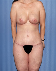 Body Lift After Photo by Siamak Agha, MD PhD FACS; Newport Beach, CA - Case 43864
