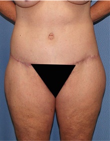 Body Lift After Photo by Siamak Agha, MD PhD FACS; Newport Beach, CA - Case 43878