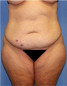 Body Lift Before Photo by Siamak Agha, MD PhD FACS; Newport Beach, CA - Case 43878