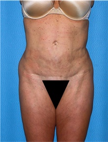 Body Lift Before Photo by Siamak Agha, MD PhD FACS; Newport Beach, CA - Case 43957