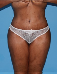 Body Lift After Photo by Siamak Agha, MD PhD FACS; Newport Beach, CA - Case 43976
