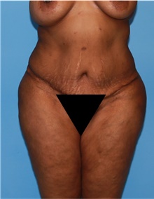 Body Lift Before Photo by Siamak Agha, MD PhD FACS; Newport Beach, CA - Case 43976