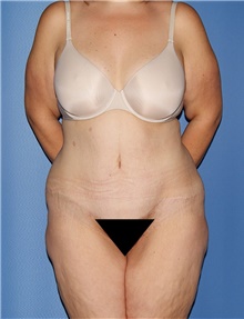 Body Contouring Before Photo by Siamak Agha, MD PhD FACS; Newport Beach, CA - Case 44003