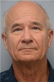 Brow Lift After Photo by Carlos Rivera-Serrano, MD; Miami Beach, FL - Case 44590