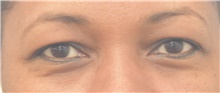 Eyelid Surgery Before Photo by Keshav Magge, MD; Bethesda, MD - Case 44764