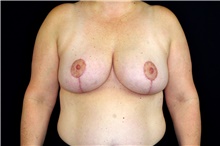 Breast Reduction After Photo by Landon Pryor, MD, FACS; Rockford, IL - Case 45107