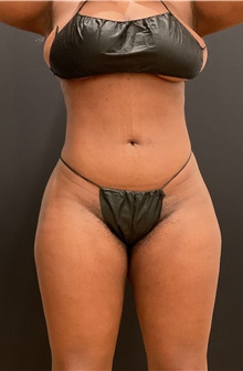 Buttock Lift with Augmentation After Photo by Johnny Franco, MD; Austin, TX - Case 45808