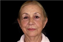 Brow Lift After Photo by Landon Pryor, MD, FACS; Rockford, IL - Case 45889