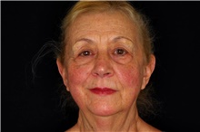 Brow Lift Before Photo by Landon Pryor, MD, FACS; Rockford, IL - Case 45889