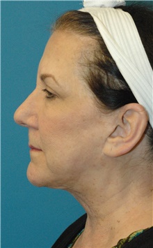 Facelift After Photo by Scott Sattler, MD,  FACS; Seattle, WA - Case 46083