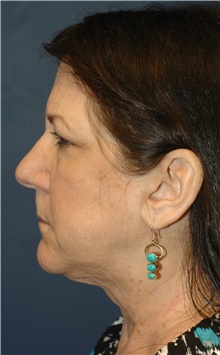 Facelift Before Photo by Scott Sattler, MD,  FACS; Seattle, WA - Case 46083