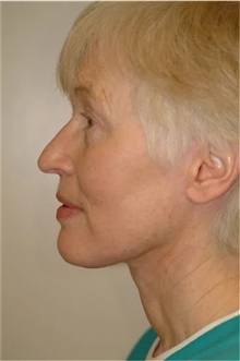 Facelift After Photo by Franklin Richards, MD; Bethesda, MD - Case 46136