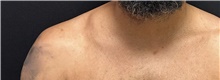 Liposuction Before Photo by Michelle Copeland, MD, DMD, FACS, PC; New York, NY - Case 46974