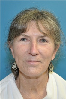 Facelift After Photo by Joshua Cooper, MD; Seattle, WA - Case 47226
