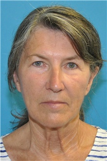 Facelift Before Photo by Joshua Cooper, MD; Seattle, WA - Case 47226