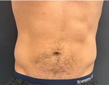 Body Contouring After Photo by David Rapaport, MD; New York, NY - Case 47251