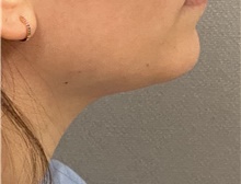 Liposuction After Photo by Keshav Magge, MD; Bethesda, MD - Case 47342
