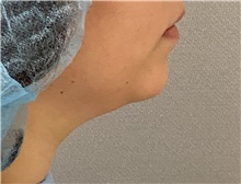 Liposuction Before Photo by Keshav Magge, MD; Bethesda, MD - Case 47342