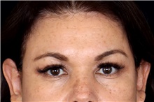 Brow Lift After Photo by Landon Pryor, MD, FACS; Rockford, IL - Case 47453